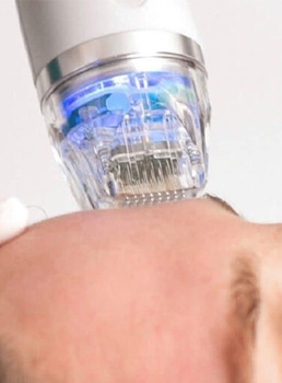 rf microneedling usage